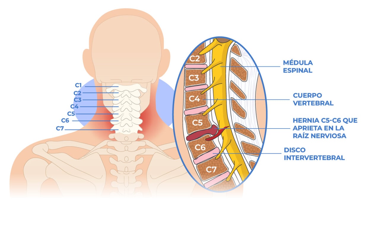 Cervicobraquialgia