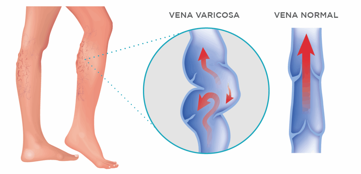 Várices