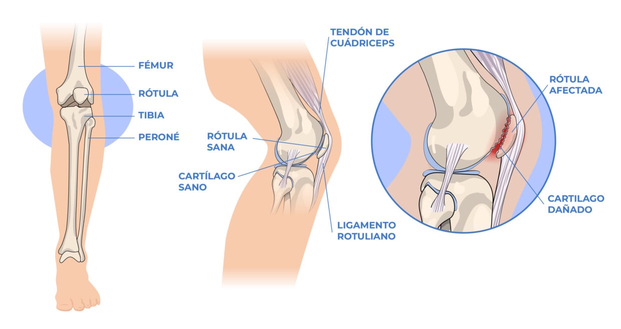Condromalacia Rotuliana o Patelar