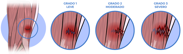 desgarro muscular