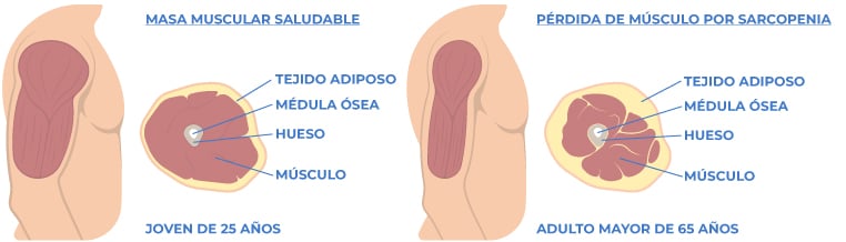 Sarcopenia 