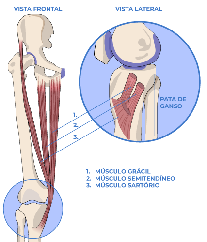 Tendinitis de Pata de ganso Tendinitis de Pata de ganso