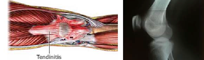 Tendinopatía o Tendinitis cuadricipital