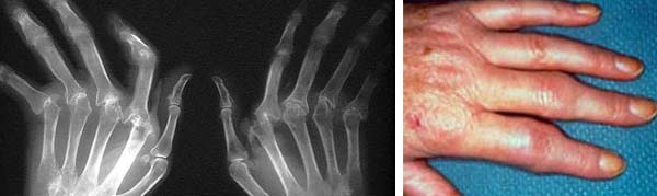 Artritis Reumatoide