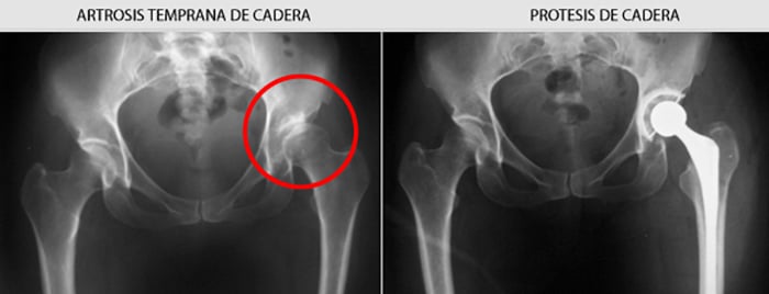 Artrosis, Artritis y Osteoporosis. Las 7 preguntas más frecuentes y sus respuestas