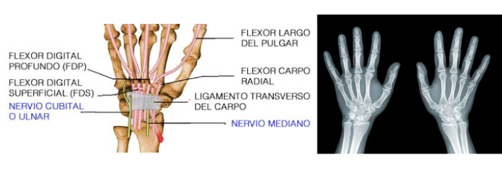 Lesión Fibrocartílago Triangular o FCT