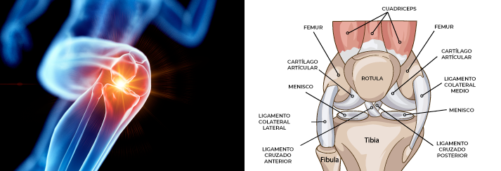 Luxación Aguda de Rótula