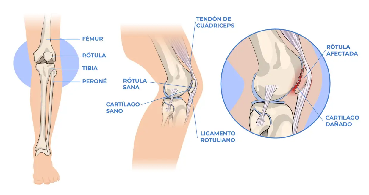 Artrosis de rodilla, causas, clasificación, tratamiento y ejercicios