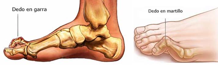 Deformidades de los Ortejos o dedos del pie
