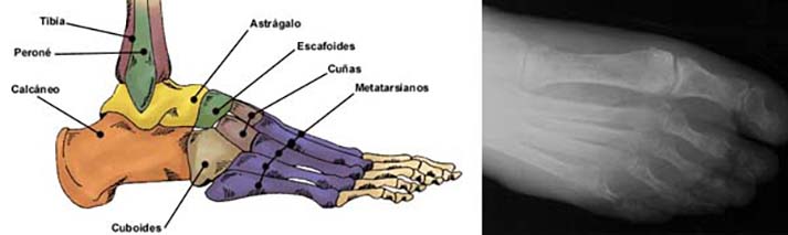 Deformidades de los Ortejos o dedos del pie
