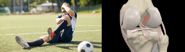 Lesiones de Rodilla más comunes en Fútbol