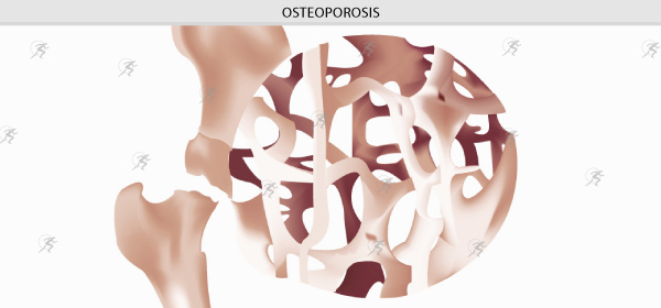 Artrosis, Artritis y Osteoporosis. Las 7 preguntas más frecuentes y sus respuestas